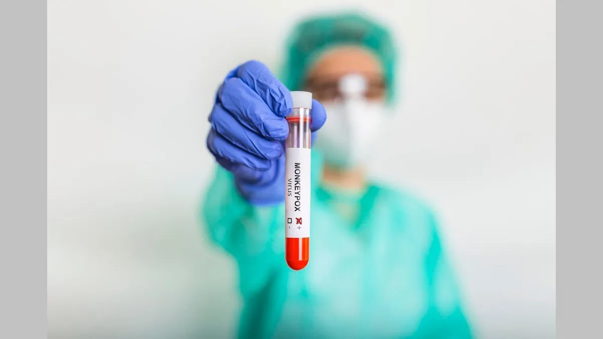 The US to Expand Testing of Monkeypox to Large Commercial Labs