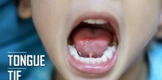 tongue tie