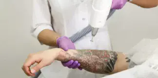 How Much Should You Budget for Tattoo Removal