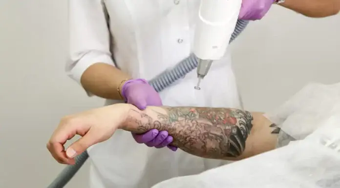 How Much Should You Budget for Tattoo Removal