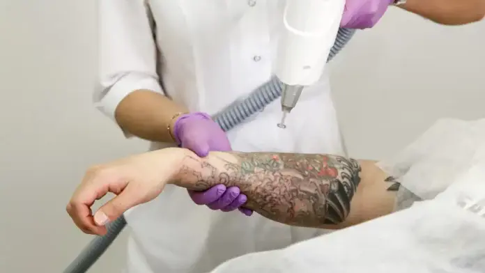 How Much Should You Budget for Tattoo Removal