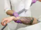 How Much Should You Budget for Tattoo Removal